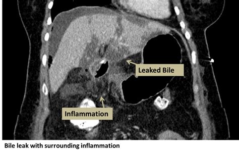 b4il3e leaks|Bile Leakage